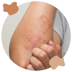 eczema-dermatitis